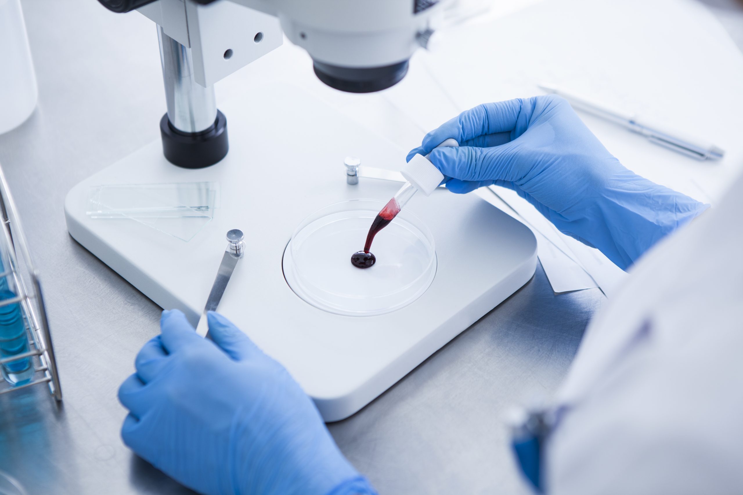 NonInvasive Blood Assay Detects Early Colorectal Cancer