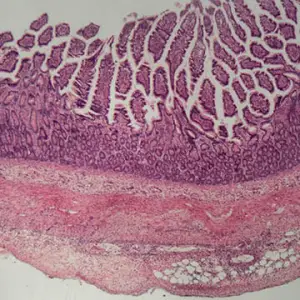Gut Guide - Microscopic Colitis