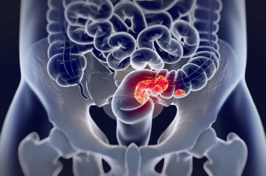 We Changed the Environment. Our Colons Are Responding.